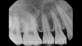 XRay lesson series 1  Full Mouth X rays [upl. by Ziza]