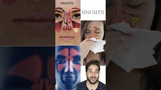 Home Remedies for Sinusitis Relief Natural Treatments and SelfCare Tips Treat sinusitis at home [upl. by Adnahsam]