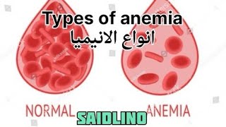 انواع الأنيميا شرح للطاقم الطبي Types of anemia [upl. by Shem194]