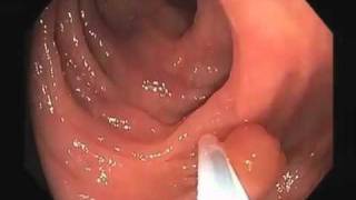 Colonoscopy Video Tour Removal of a Colon Polyp Polypectomy [upl. by Bigod418]