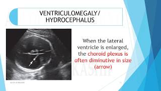 VENTRICULOMEGALYHYDROCEPHALUS A2Z of Ultrasound [upl. by Clemens]