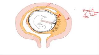 Gestational trophoblastic disease part 1 Introduction [upl. by Asoramla859]