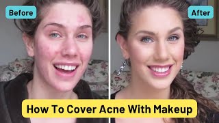 Foundation Routine For Acne  How To Cover Pimples Scars Cystic Acne Blackheads amp Oil [upl. by Camella539]