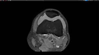 Knee injury LCL Bursa [upl. by Lednic657]