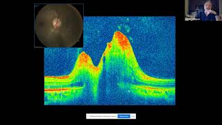 OCT in Neuro ophthalmic Disorders [upl. by Casavant201]