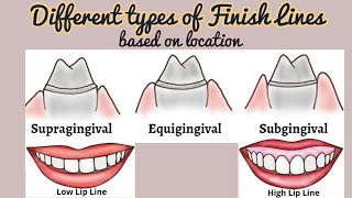 Types of Finish Lines based on Location Finish Lines in Fixed Partial Denture Tooth Preparation [upl. by Anaidni169]