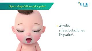 Sospecha clinica de Atrofia muscular espinal [upl. by Atilrak]