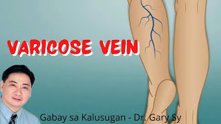 Varicose Vein  Dr Gary Sy [upl. by Eltsyek]