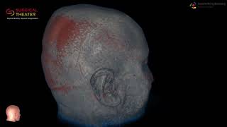 Resection of Brain Stem Cavernoma Minimally Invasive Surgery [upl. by Hodess]