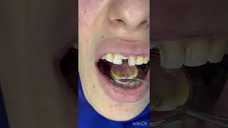 التجميل الطبيعي للاسنان  بدون برد 🤯🚨🚨dentalesthetics اكسبلور dentist dentalcare ترند [upl. by Desi]