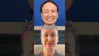 AMAZING complex facial reanimation surgery 1 month post op results facialparalysis plasticsurgery [upl. by Arbed482]