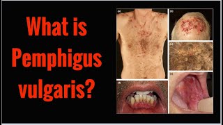 What is PEMPHIGUS VULGARIS Symptoms Causes [upl. by Nrubloc96]