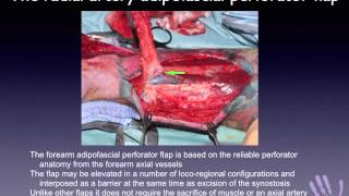 Adipofascial flaps for post traumatic forearm synostosis [upl. by Lemrac93]