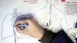 Liver Cirrhosis [upl. by Constancy]