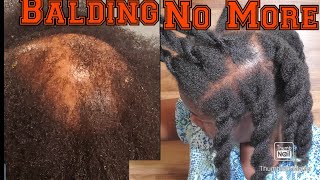 Alopecia update Powerful Ginger Onion and black Jamaican castor oil hair growth recipes working [upl. by Alamap]