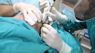 Ablatie cu laser CO2 tumoreta scalp Dr Jianu ProEstetica [upl. by Tremann779]