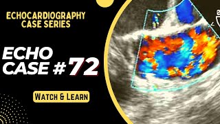 ECHO CASE 72  Echocardiography for Beginners  Echo spot diagnosis Series  Cardiology [upl. by Logan]