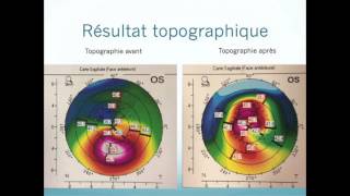 Photokératectomie thérapeutique PKT topoguidée sur le kératocône [upl. by Ttayw97]