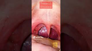 Tonsil Stones Removal Procedure All compilation [upl. by Lamonica]