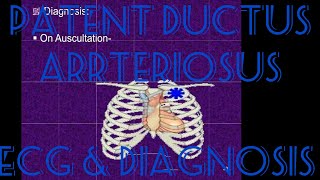 Patent ductus arteriosus ECG GUCH CHD Congenital heart disease paediatricCardiology [upl. by Cynarra]