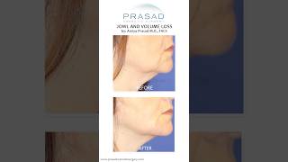 How Treatment for Jowls can be Done with Filler jowls [upl. by Gnay]