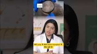 Is scalp hair good for a beard hair transplant  Beard Hair Transplant  Chandra Hair Clinic [upl. by Ahsiak221]