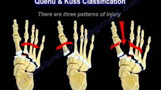 Lisfranc Injuries  Everything You Need To Know  Dr Nabil Ebraheim [upl. by Atteras]