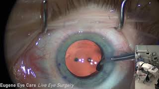 Eugene Eyecare Live Cataract Surgery [upl. by Dranreb]