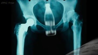 Top 20 Most Weird Objects Found In Human Rectum XRay [upl. by Edya109]