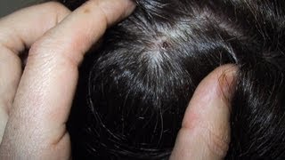 How to Treat a Dry Scalp DermTVcom Epi 482 [upl. by Lyj]