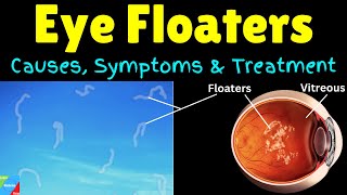 What are Eye Floaters  Causes Symptoms Treatment amp Prevention [upl. by Nodyarb]