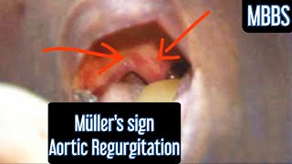 Müllers sign in Aortic Regurgitation mbbs medicine usmle neetpg inicet next aiims cvs [upl. by Ielerol]