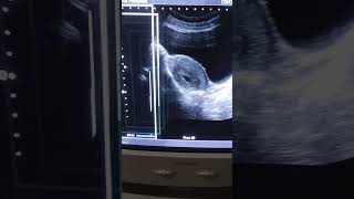 Gestational sac of 4 weeks with transabdominal ultrasound by medical radiology [upl. by Bashuk]