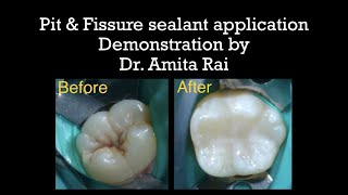 Pit amp Fissure sealant application Demonstration by Dr Amita Rai [upl. by Boycey]