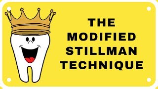 Modified Stillman Technique [upl. by Nurav]