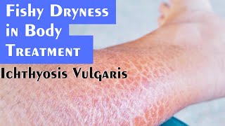 Ichthyosis Vulgaris Fishy Dryness Explained by Dr Rohit Goel [upl. by Schwitzer]