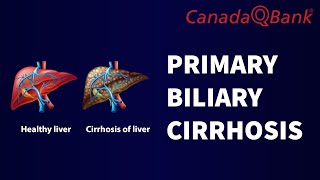 Primary Biliary Cirrhosis [upl. by Amsirp707]