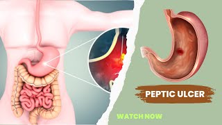 Peptic ulcer disease – causes symptoms diagnosis amp treatment [upl. by Gibeon]