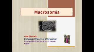 Macrosomia [upl. by Artie]