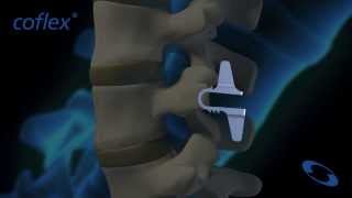 coflex® NonFusion Implant in Flexion and Extension  Paradigm Spine [upl. by Soo178]