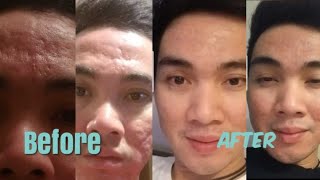 Home microneedling Dermapen 5th session using niacid by slurp how get rid acne scar [upl. by Dabbs605]