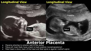 Placenta Positions On Ultrasound  AnteriorPosteriorFundalLateral Placental Positioning USG [upl. by Naamann]