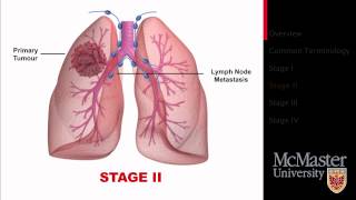 Lung Cancer Staging Presentation [upl. by Notsyrb]