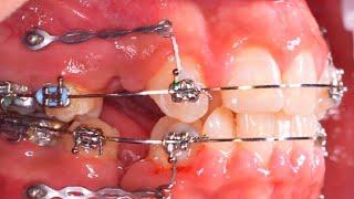 CROWDING TEETH CORRECTION by BRACES [upl. by Alemap]