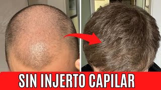 Descubre como recuperó el pelo SIN INJERTO CAPILAR 😮 EVOLUCIÓN CAPILAR [upl. by Yedarb]