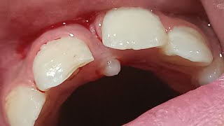 supernumerary tooth mesiodens  زوائد الاسنان [upl. by Affrica]