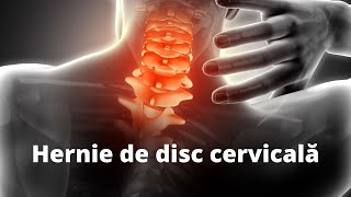 Ce este hernia de disc cervicală kinetoterapie durerecervicala [upl. by Seagraves623]