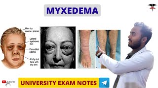 Myxedema  Hypothyroidism  Endocrine Physiology [upl. by Gilcrest]