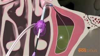 Balloon Sinuplasty Treatment for Chronic Sinusitis  NonInvasive Sinus Procedure [upl. by Rodrigo]