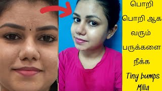 How to get rid of Miliatiny bumps naturally  Home remedy for tiny bumpsMilia at home in Tamil [upl. by Leelah]